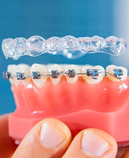 img-advantage-of-clear-aligners