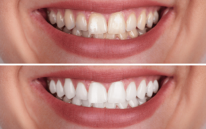 can teeth whitening damage your teeth