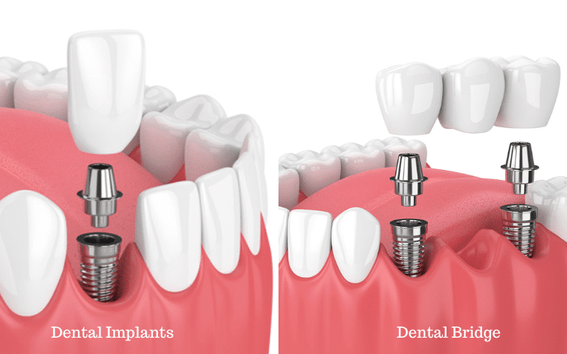 dental implant or dental bridges: which one is better?