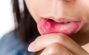 What Are The Effects Of Poor Oral Hygiene?