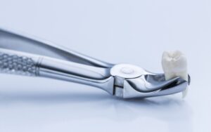 Anesthesia for Tooth Extraction