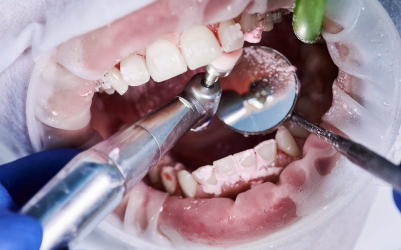 Is It Necessary to Take Antibiotics Before Dental Cleaning