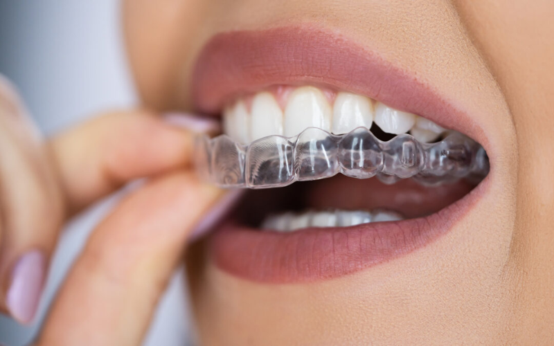 maintain your clear aligners while traveling