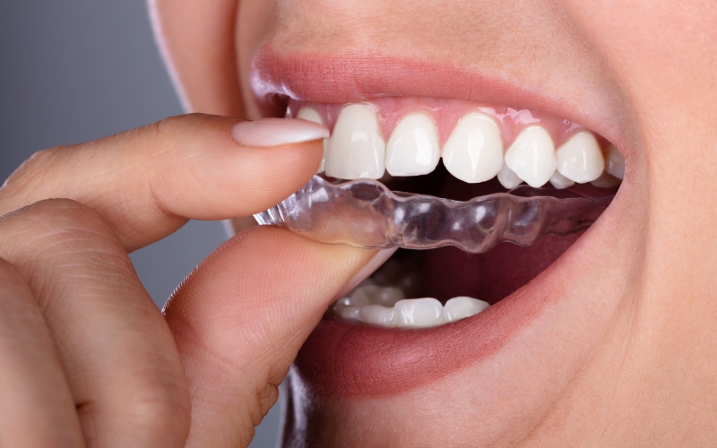 clear-aligners-for-adults-over-40