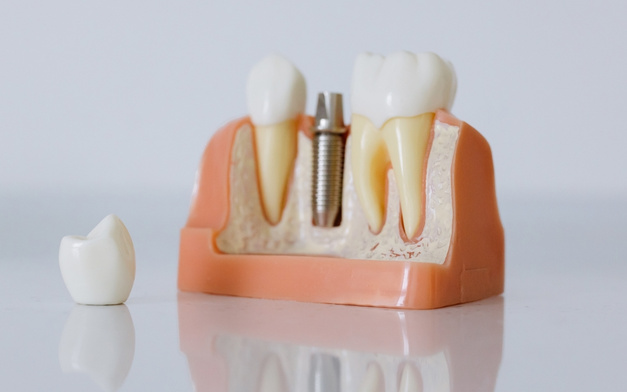 why dental implants are a popular tooth replacement option