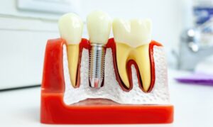 dental implants in Whitehall