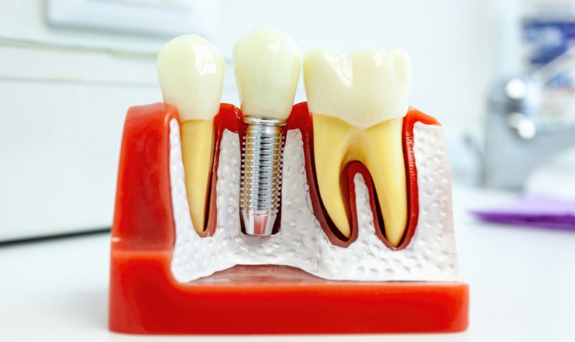 dental implants in Whitehall