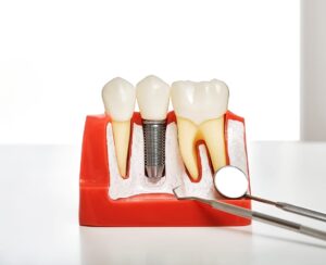 Dental Implants in Whitehall